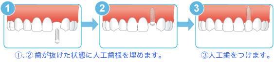 インプラントの治療のイラスト