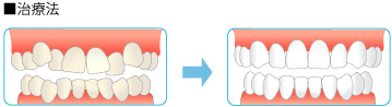 補綴矯正の治療法