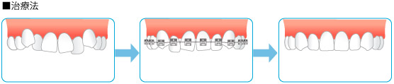 矯正治療の治療法