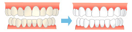 ホワイトニングのイラスト